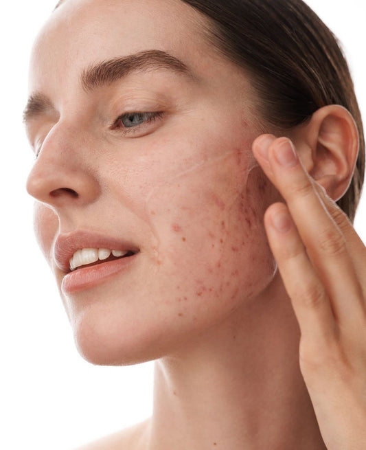 Acne Dryer منشف حبوب