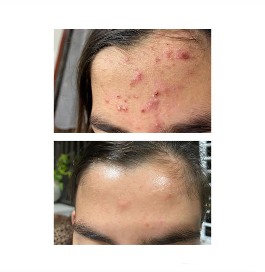 بكج علاجي فعال لمعالجة الحبوب الملتهبة - حل جذري لمشكلة البشرة الدهنية والحبوب بكل انواعه